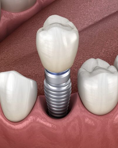 Teeth Implants