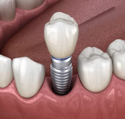 Teeth Implants