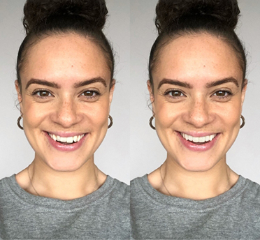 Invisalign Case – Before and After