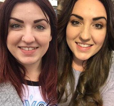 Invisalign – Before and After Photos