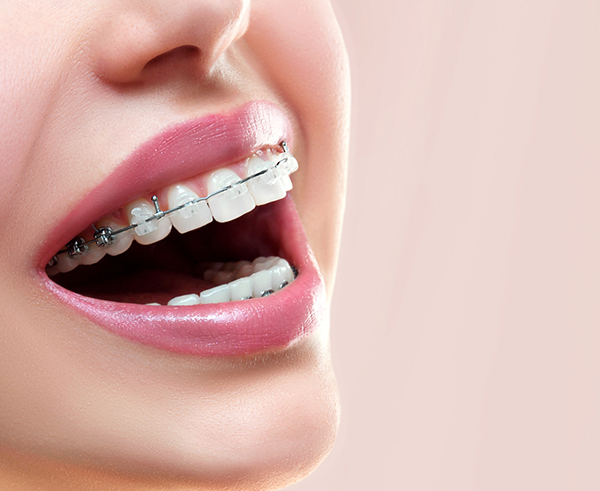 Traditional Braces